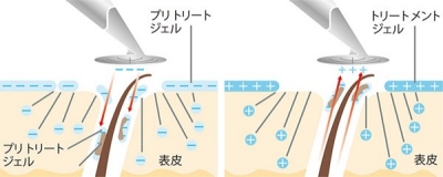 lp_galvanic-gel_action